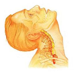 Osteochondroza kręgosłupa szyjnego