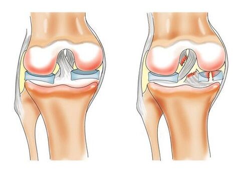 zdrowe kolano i artroza stawu kolanowego
