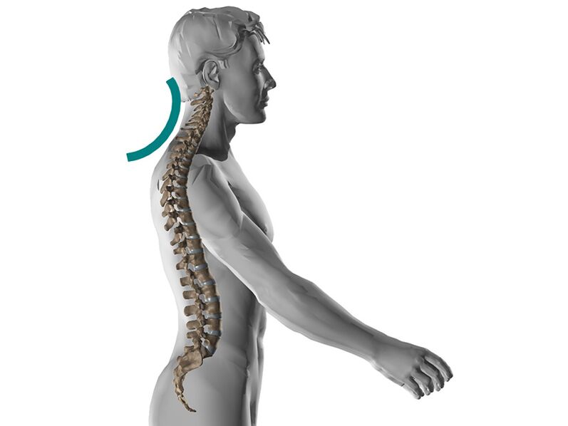 Osteochondroza szyjna kręgosłupa, powodująca wiele nieprzyjemnych objawów